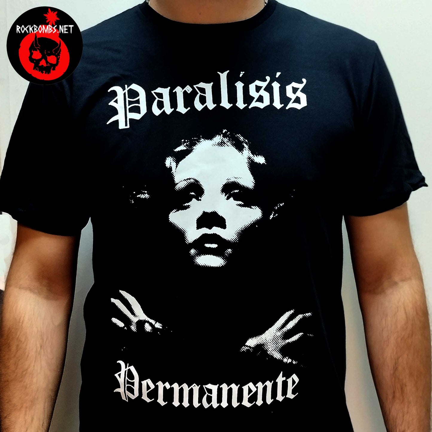 PARALISIS PERMANENTE